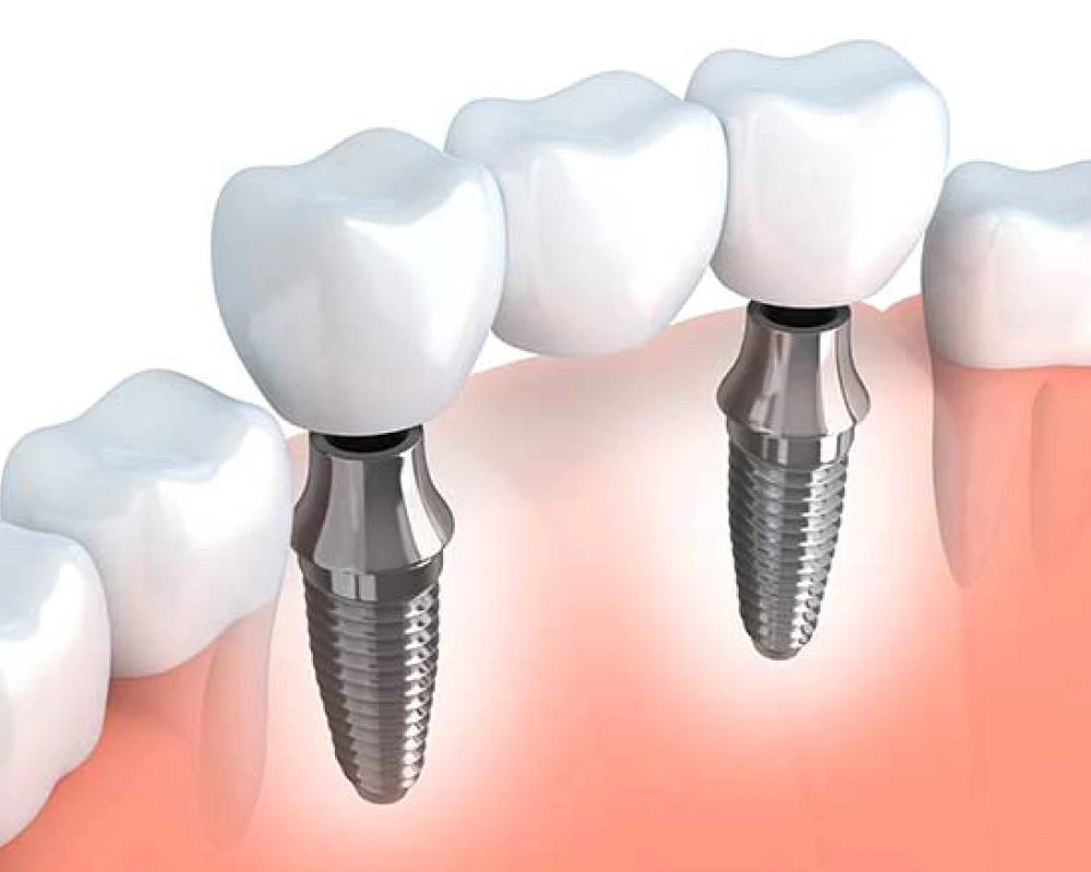 Impianti denti per la bocca