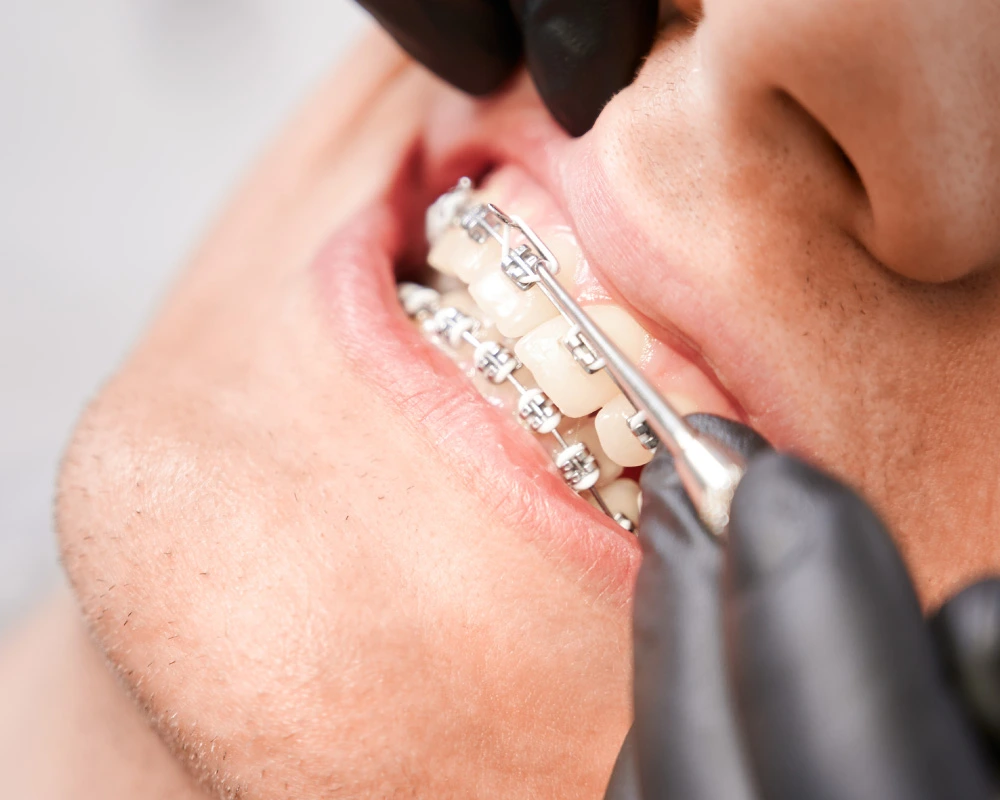 Apparecchio fisso e mobile denti