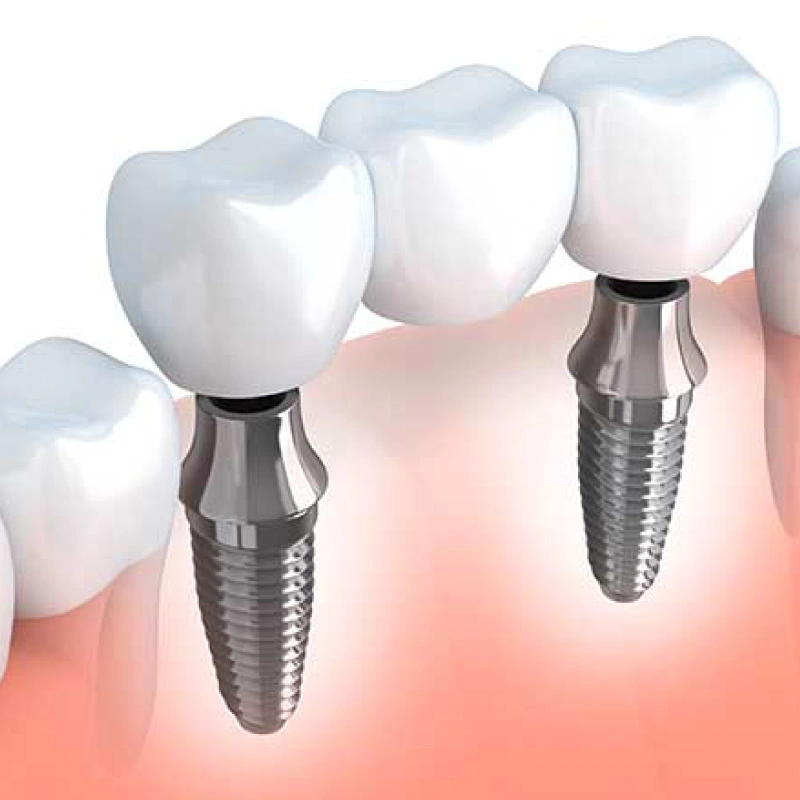 Impianti che sostituiscono i denti